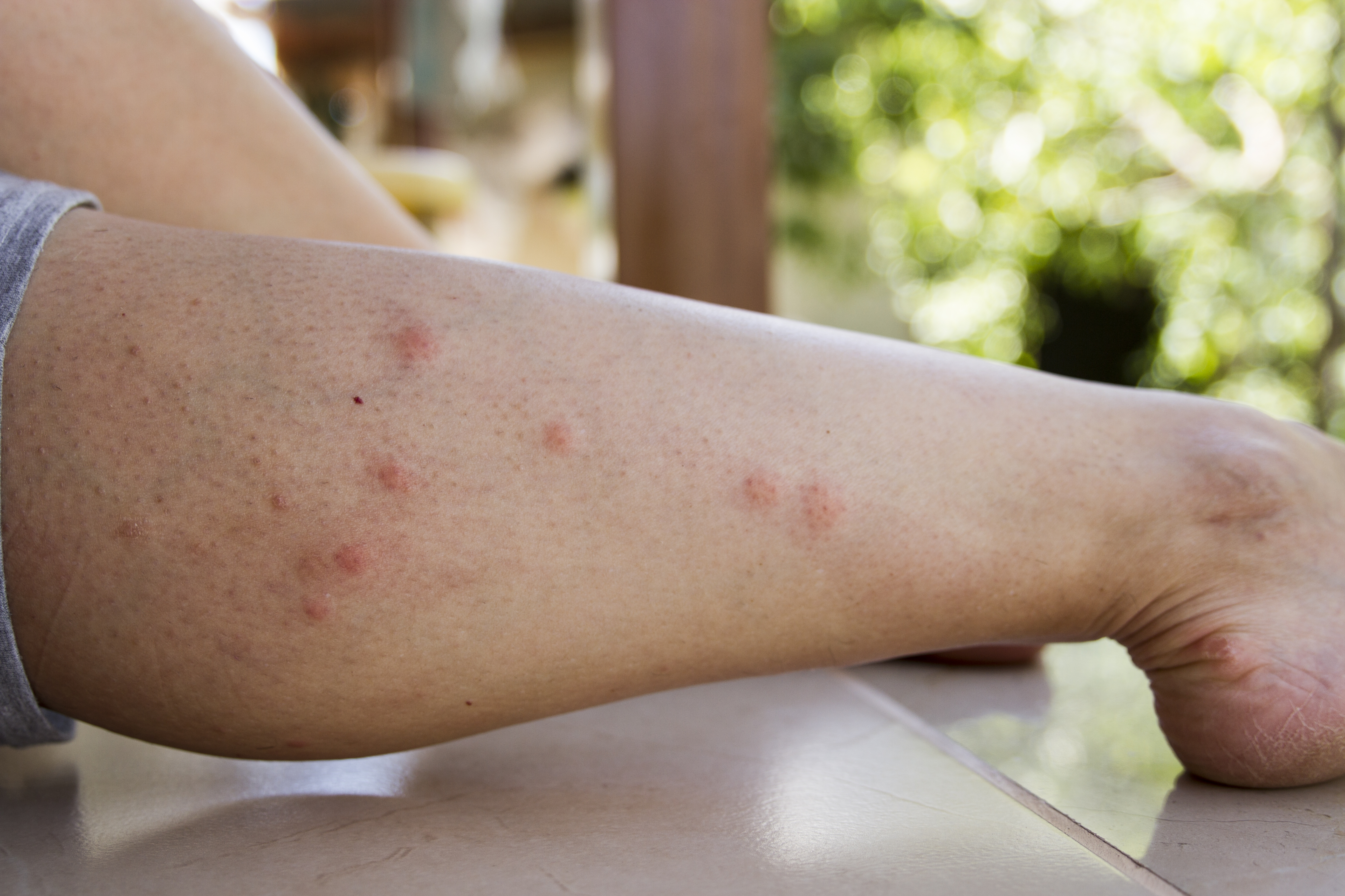 A Reddit user revealed he hasn't had any insect bites since learning a DIY trick from his grandmother (stock image)