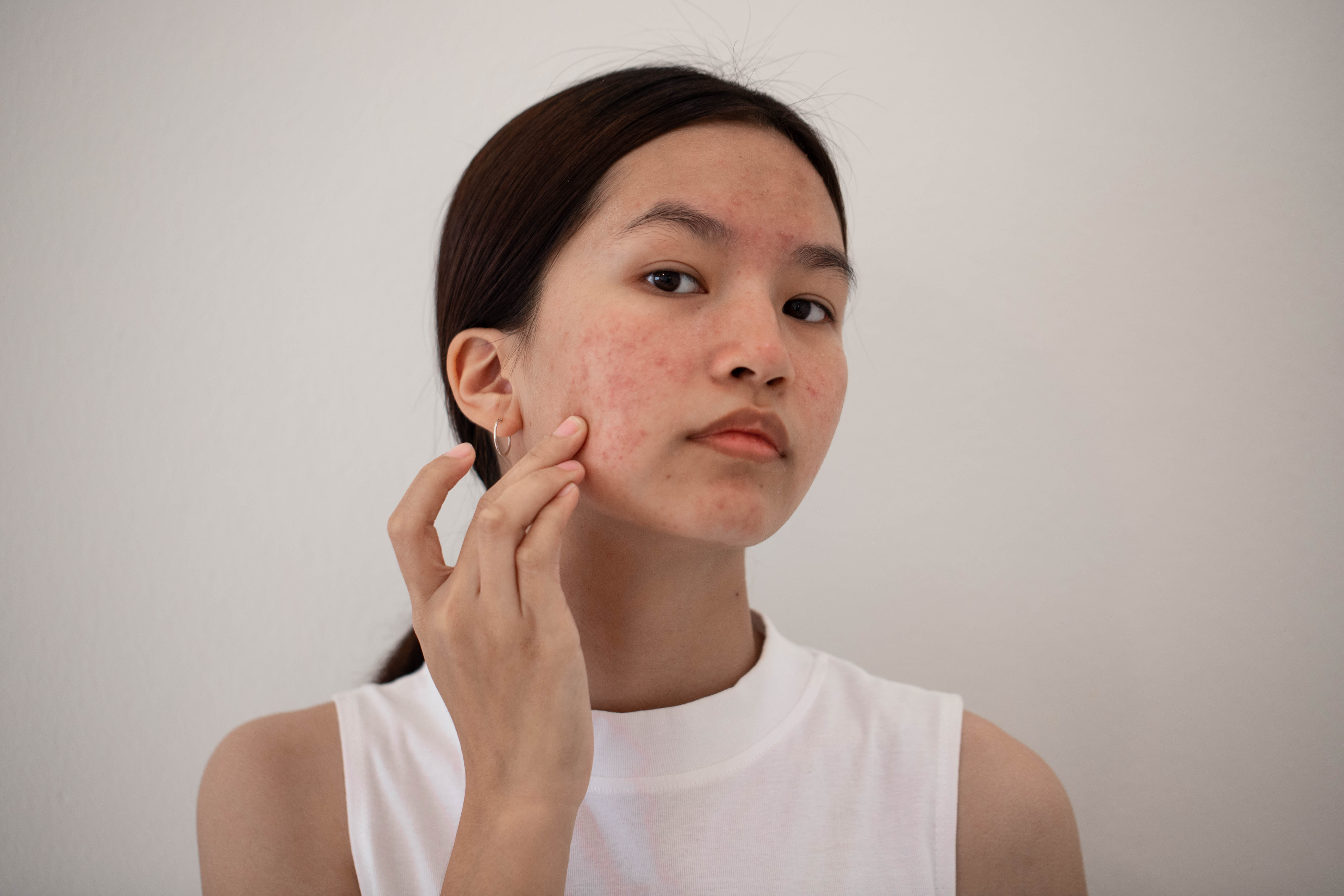 A skin care fan shared a $2 pantry product that cured their hormonal acne (stock photo)