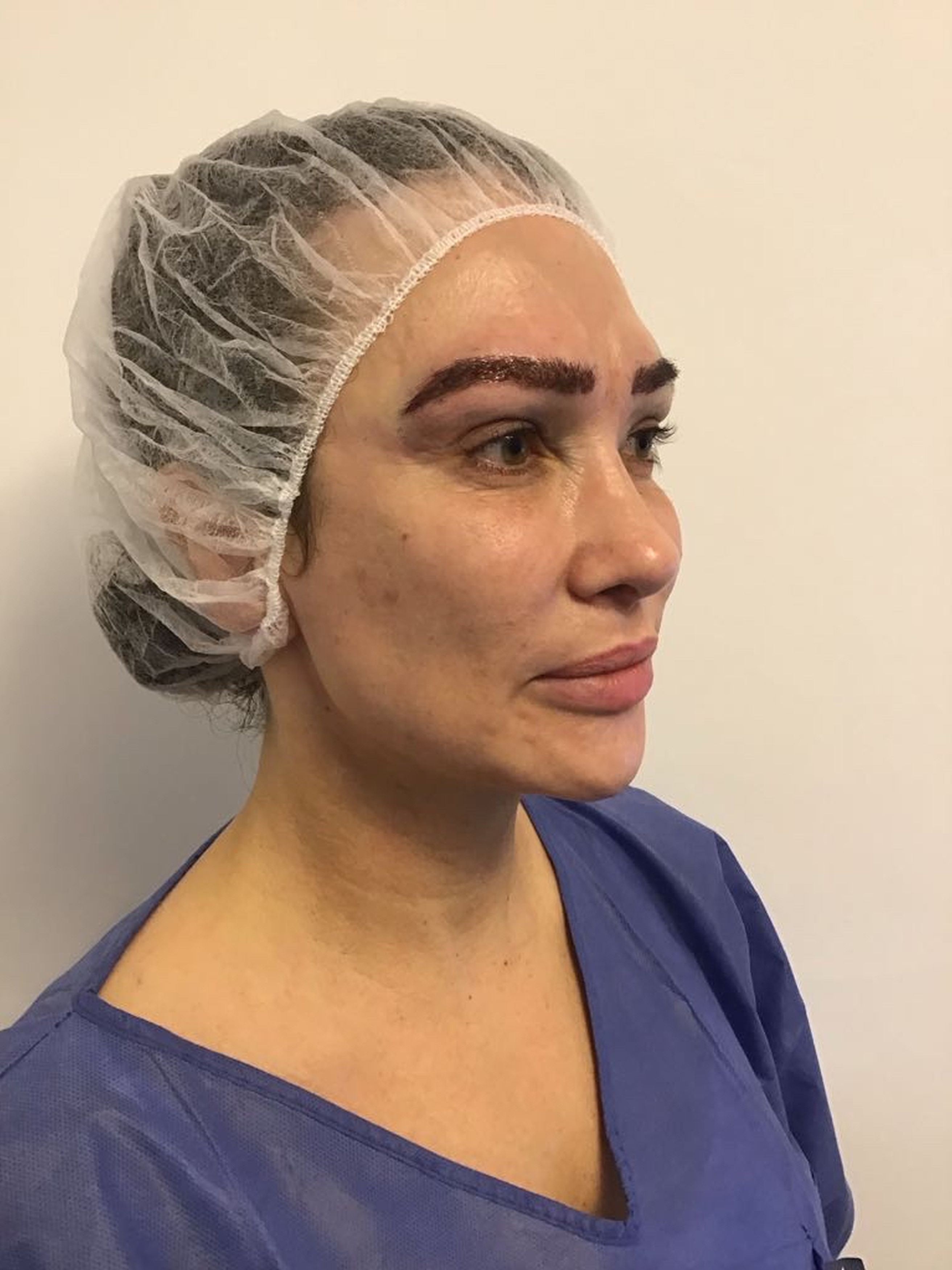 The 'billionaire's wife' decided to undergo a seven-hour eyebrow transplant