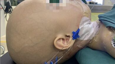 1-year-old girl has a fetus in her skull that once belonged to her twin sister