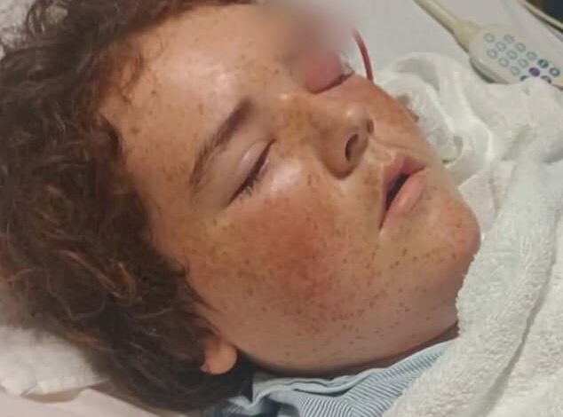 13-year-old Texas boy with plastic pipe sticking out of his head after swimming with friends caused illness that could have killed him