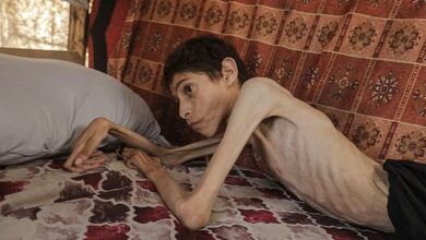 How can he still be alive? Tragic images of a 21-year-old Palestinian reduced to skin and bones as he suffers from severe malnutrition in Gaza