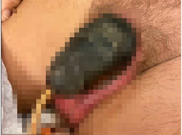 Man, 68, forced to have part of his penis amputated after it became gangrene from using a sex aid ‘for too long’