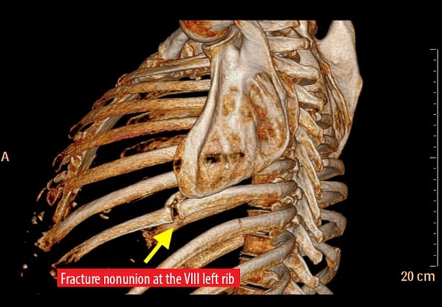 Man coughs so hard he sustains strange injury and has to have part of his body part removed