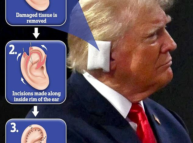 Plastic surgeon reveals Donald Trump should undergo ,000 surgery to repair bullet-damaged ear