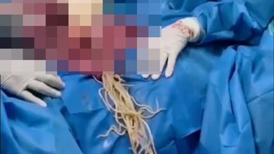 Terrifying images show what happens when giant parasitic WORMS invade the intestines – and 4 million Americans could be unknowingly suffering