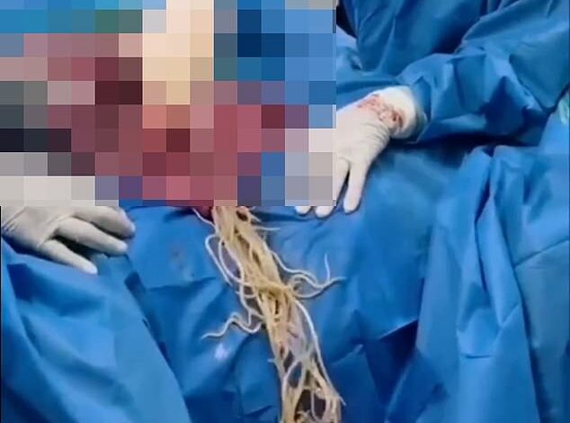 Terrifying images show what happens when giant parasitic WORMS invade the intestines – and 4 million Americans could be unknowingly suffering