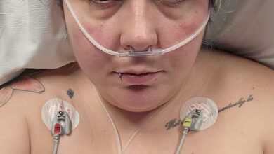 33-year-old London woman nearly died after £4.5k gastric balloon got ‘stuck’ in her intestines