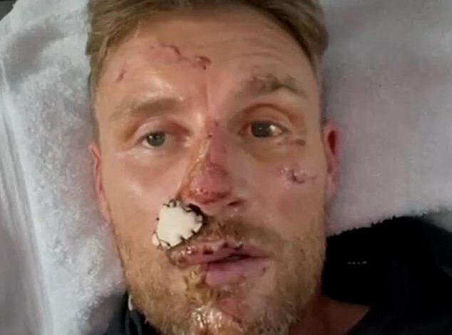 Freddie Flintoff reveals the extent of his horrific injuries in a new clip filmed a week after his crash – as he admits he will never be the same: ‘I’m really struggling and I need help. I really shouldn’t be here’