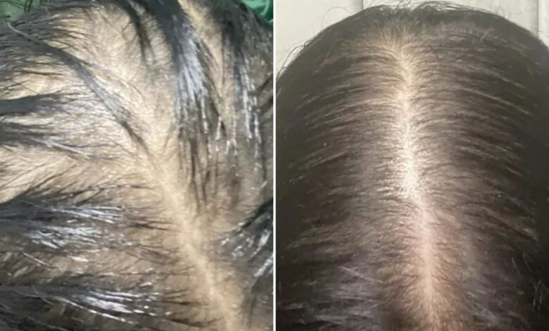 A £11 purchase from Superdrug stopped my hair from falling out, it grew back in just 6 weeks