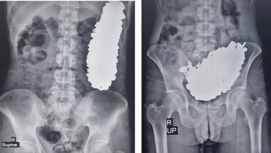 Doctors remove 452 ‘metal objects’ from man’s stomach after he swallowed bolts, keys and rocks during psychotic episode