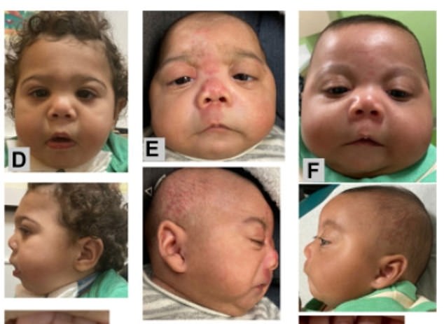 Dozens of babies diagnosed with new fentanyl-linked condition that causes deformed heads, fused toes and club feet