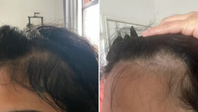 I had bald spots along my hairline – an oil from Amazon helped them grow back quickly