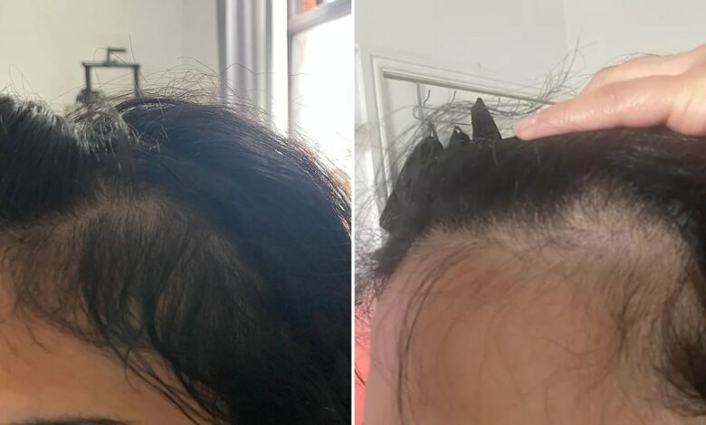 I had bald spots along my hairline – an oil from Amazon helped them grow back quickly