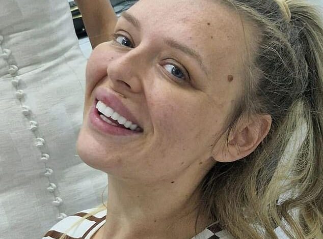 Influencer left with horse-like ‘turkey teeth’ flies back for £3,400 fix – as Love Island star smiles after vicious trolling