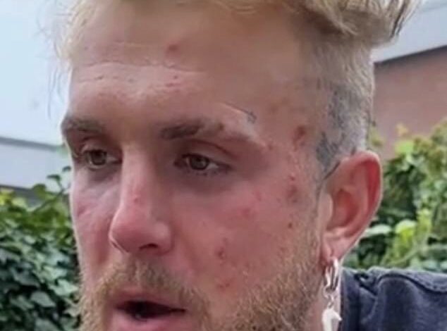 Jake Paul raises suspicion among doctors after photo of star with severe facial acne