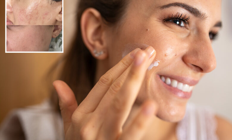 My acne cleared up instantly when I left out one ingredient – brands sneak it in