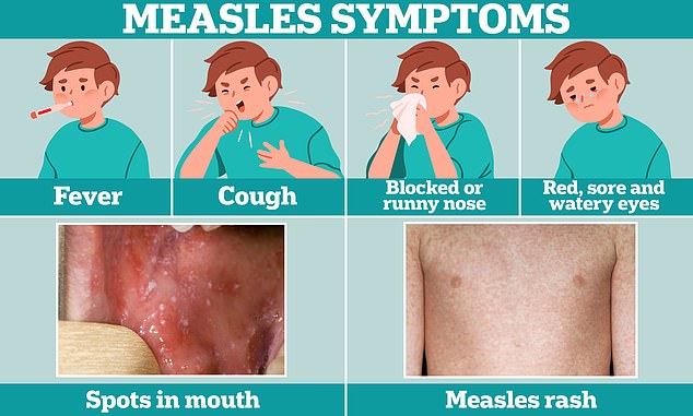 British child dies from brain swelling caused by measles – is your region a hotspot for the deadly virus?