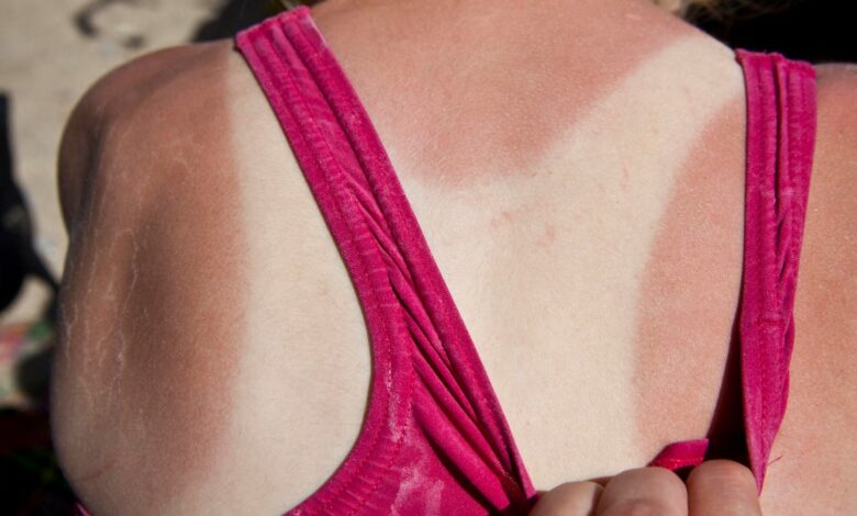 Is Your Skin Suffering From Sun Damage? We Asked Experts If You Can Reverse It