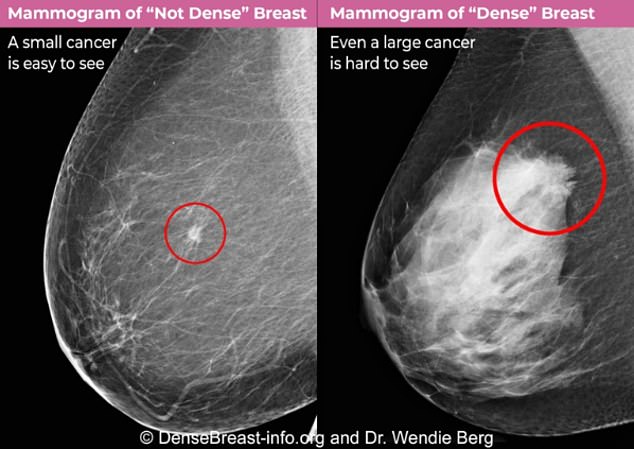 Major change for breast cancer screening in every state: ‘This is crucial’