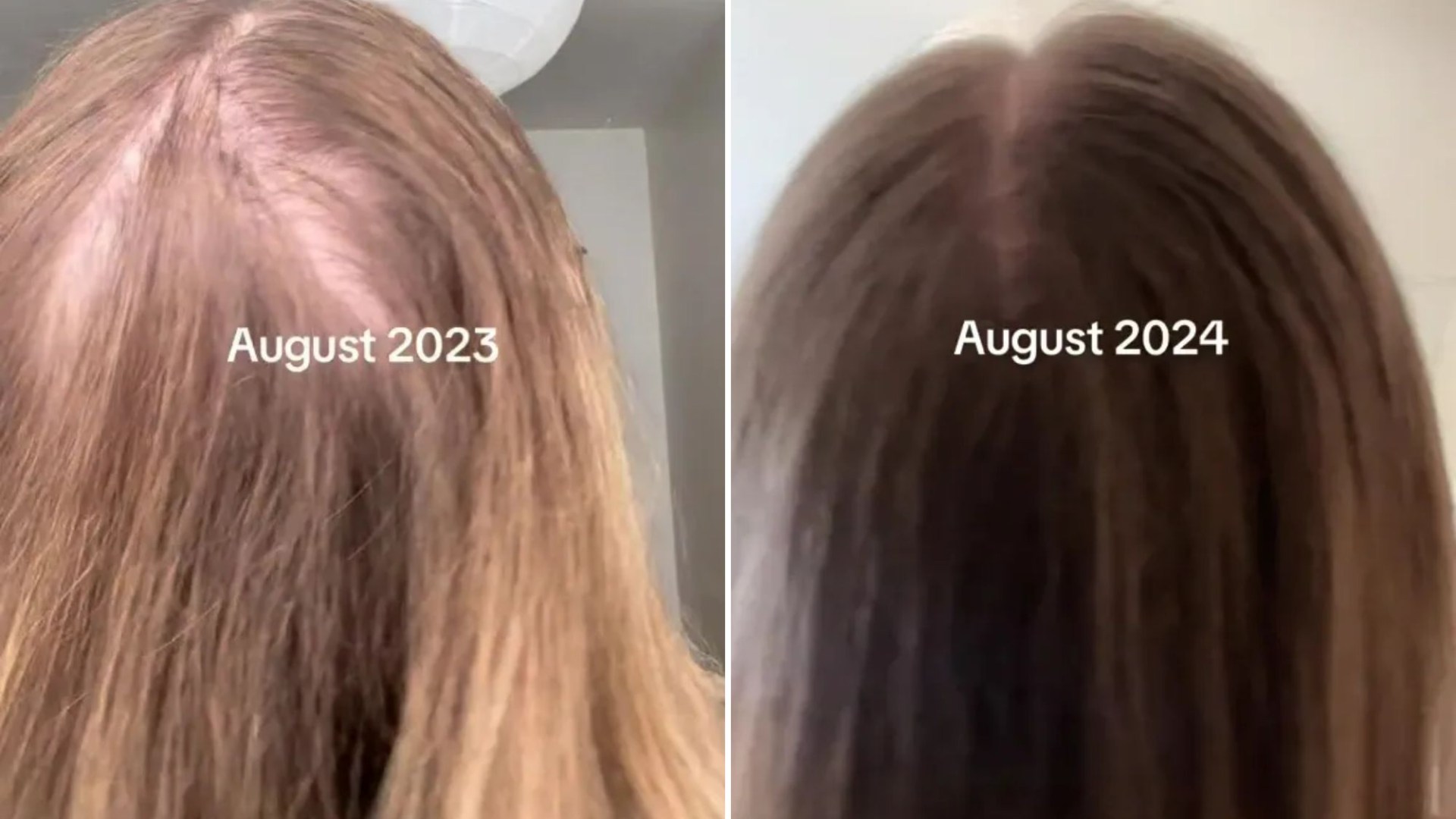 I had bald spots all over my scalp – now my hair is thick with a 10 second trick