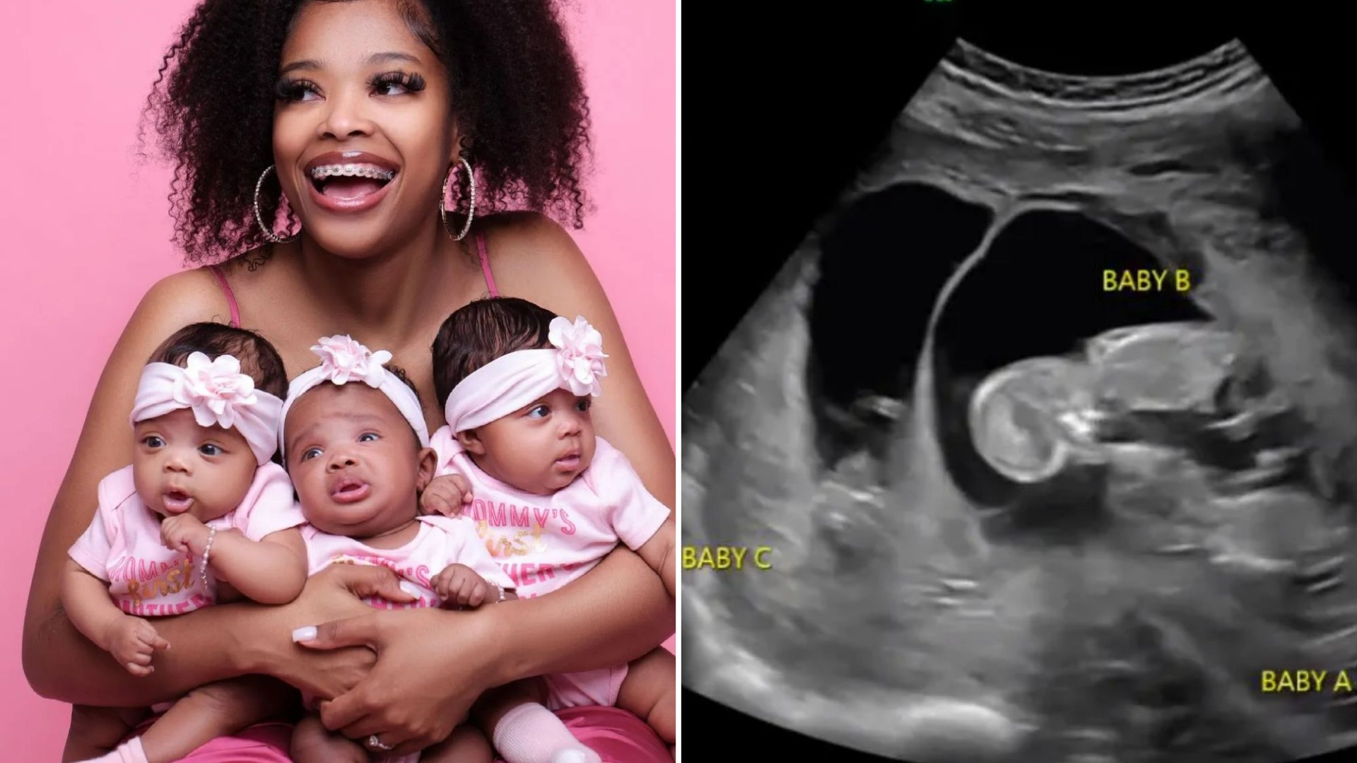 Woman gets pregnant while already pregnant, it’s only happened 10 times ever