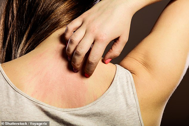 As Britain is gripped by a scabies outbreak… why are Victorian diseases returning?