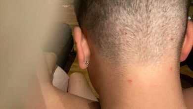 Barber warns of common cutting mistakes that cause dozens of young men to become infected with the horrific RINGWORM