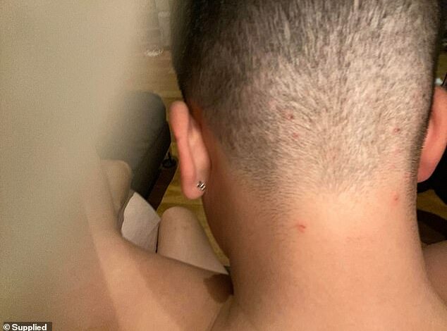 Barber warns of common cutting mistakes that cause dozens of young men to become infected with the horrific RINGWORM