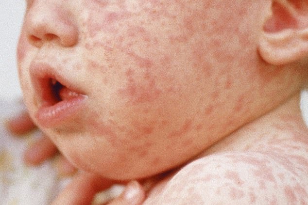 CDC warns of increase in measles and decrease in vaccinations as Trump vaccine skeptic RFK Jr. appoints as head of health care