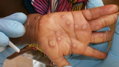 California patient is the first in the US to become infected with a deadlier form of MPox