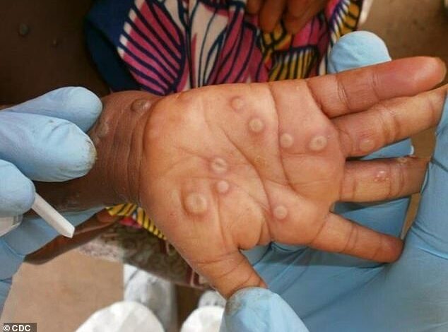 California patient is the first in the US to become infected with a deadlier form of MPox