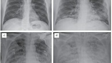 Could Your Child’s Cough Really Be ‘Walking Pneumonia’? As cases rise in the US, experts fear a deadly bug outbreak could make its way to Britain