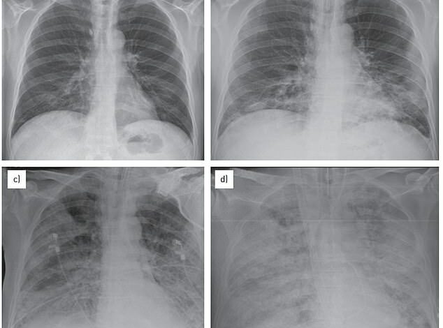 Could Your Child’s Cough Really Be ‘Walking Pneumonia’? As cases rise in the US, experts fear a deadly bug outbreak could make its way to Britain