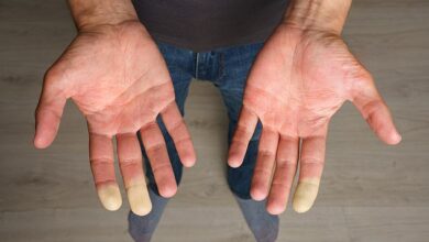 Do you have cold hands? Take the 1-minute test that shows if you have debilitating Raynaud’s disease