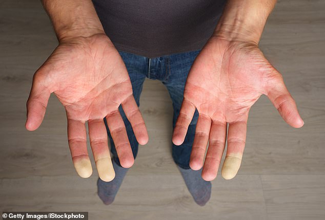 Do you have cold hands? Take the 1-minute test that shows if you have debilitating Raynaud’s disease