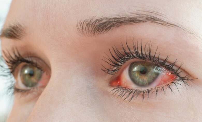 Dry, itchy eyes? Try these 7 home remedies to soothe your eyes