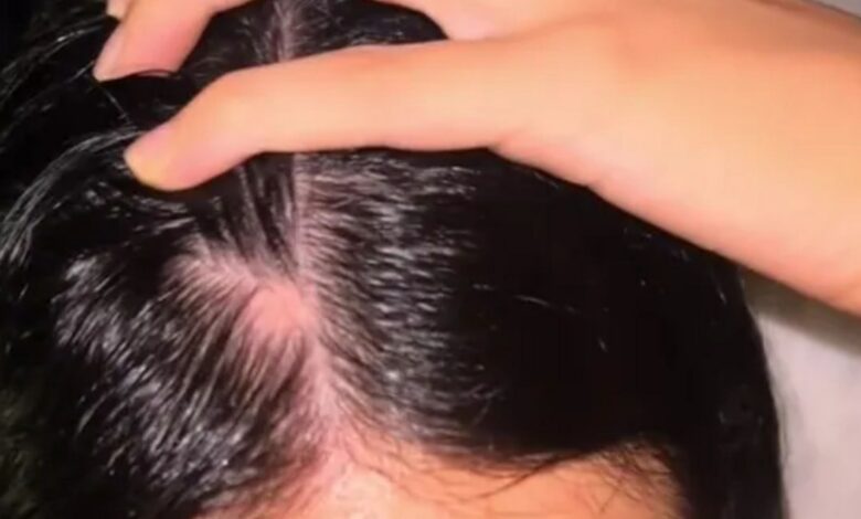 I’m 23, but I had a huge bald spot on my head. A £19 oil made my locks grow back