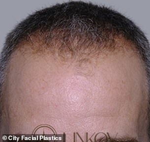 Plastic surgeon unveils ‘first-line’ drug for preventing hair loss loved by Donald Trump