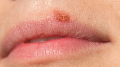 The benign spot on your lip that DOUBLE your risk of dementia