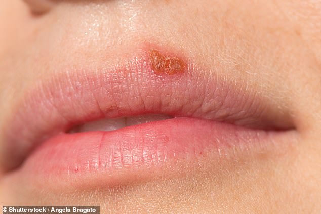 The benign spot on your lip that DOUBLE your risk of dementia