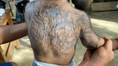 Concerns over babies developing bizarre ‘werewolf syndrome’ after parents use a popular hair loss drug