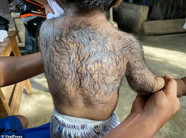 Concerns over babies developing bizarre ‘werewolf syndrome’ after parents use a popular hair loss drug